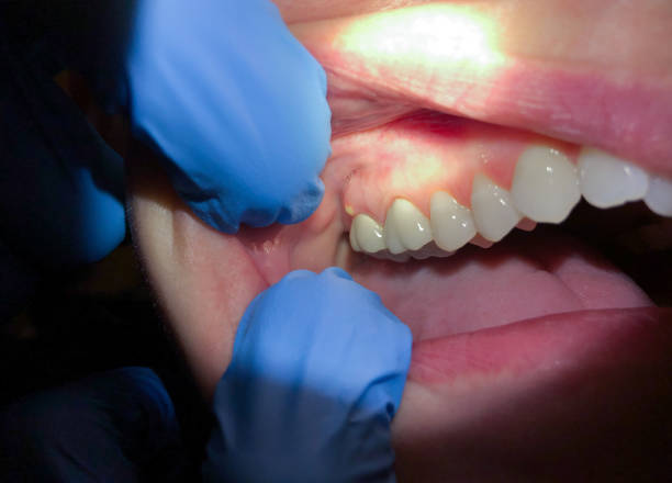 Best Emergency Dental Care for Broken or Chipped Teeth in New Philadelphia, OH