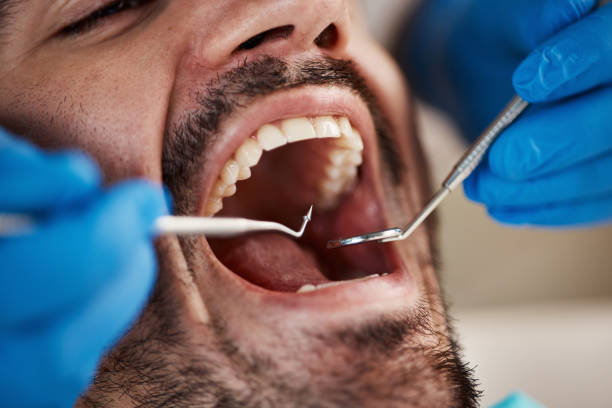 Best Emergency Treatment for Dental Infections or Abscesses in New Philadelphia, OH